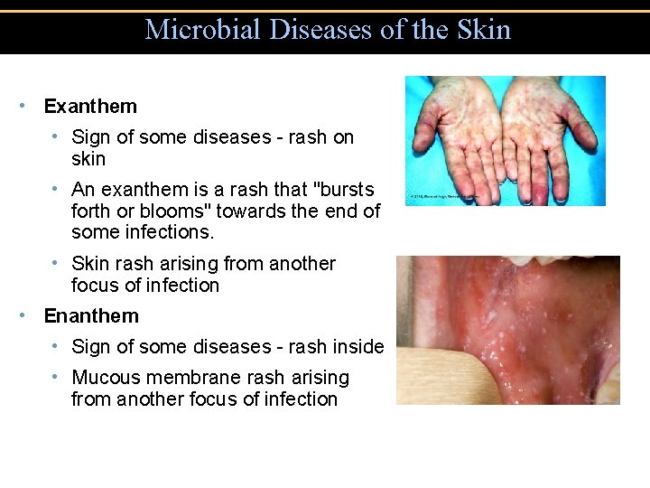Microbial Diseases of the Skin • Exanthem • Sign of some diseases - rash