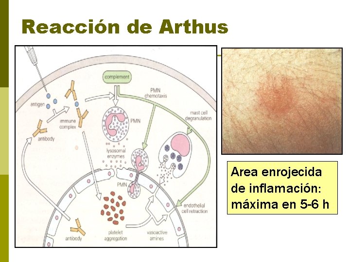 Reacción de Arthus Area enrojecida de inflamación: máxima en 5 -6 h 