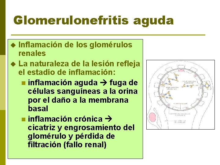 Glomerulonefritis aguda u u Inflamación de los glomérulos renales La naturaleza de la lesión