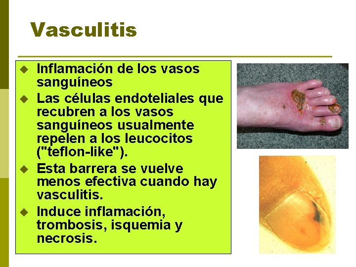 Vasculitis u u Inflamación de los vasos sanguíneos Las células endoteliales que recubren a