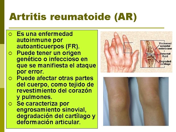 Artritis reumatoide (AR) ¢ ¢ Es una enfermedad autoinmune por autoanticuerpos (FR). Puede tener
