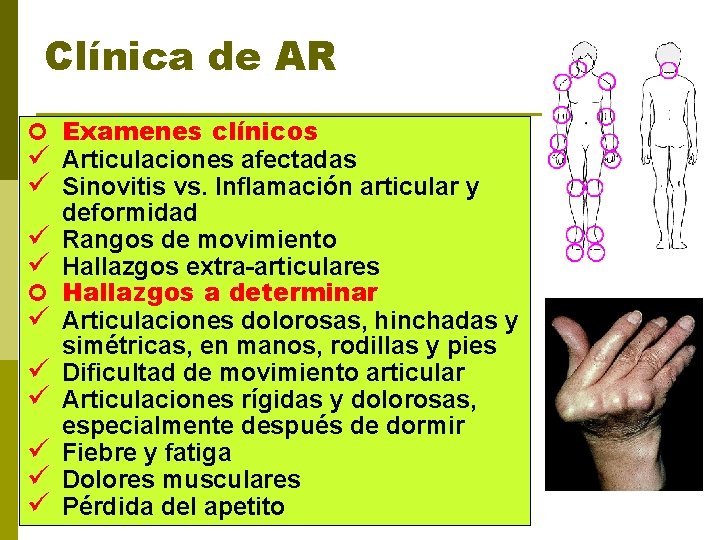 Clínica de AR ¢ Examenes clínicos ü Articulaciones afectadas ü Sinovitis vs. Inflamación articular
