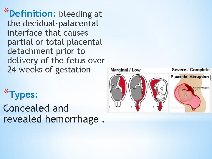 *Definition: bleeding at the decidual-palacental interface that causes partial or total placental detachment prior