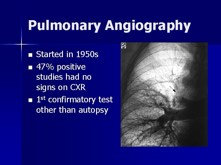 Pulmonary Angiography n n n Started in 1950 s 47% positive studies had no