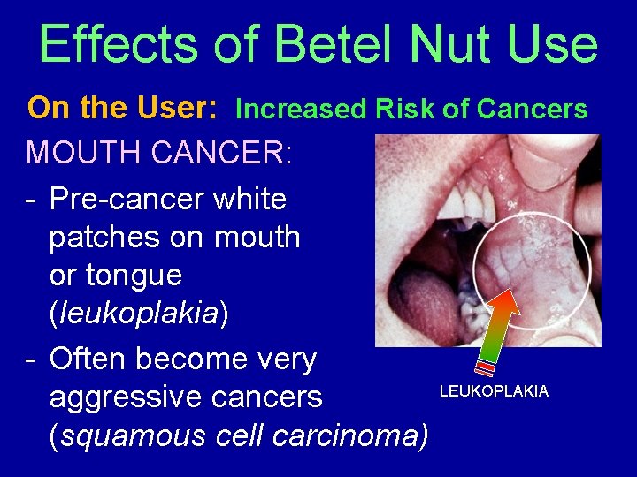 Effects of Betel Nut Use On the User: Increased Risk of Cancers MOUTH CANCER: