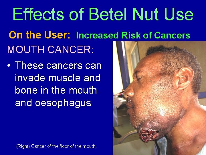Effects of Betel Nut Use On the User: Increased Risk of Cancers MOUTH CANCER: