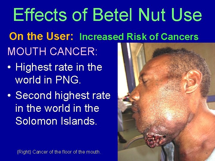 Effects of Betel Nut Use On the User: Increased Risk of Cancers MOUTH CANCER:
