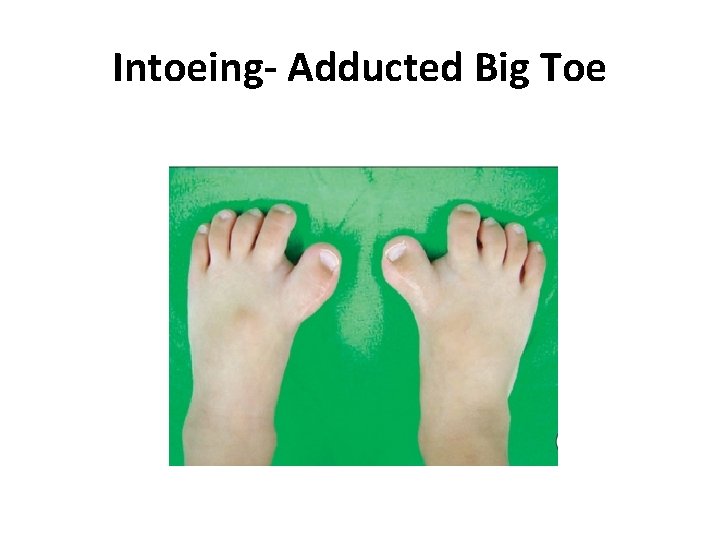 Intoeing- Adducted Big Toe Intoeing- Adducted Big Toe