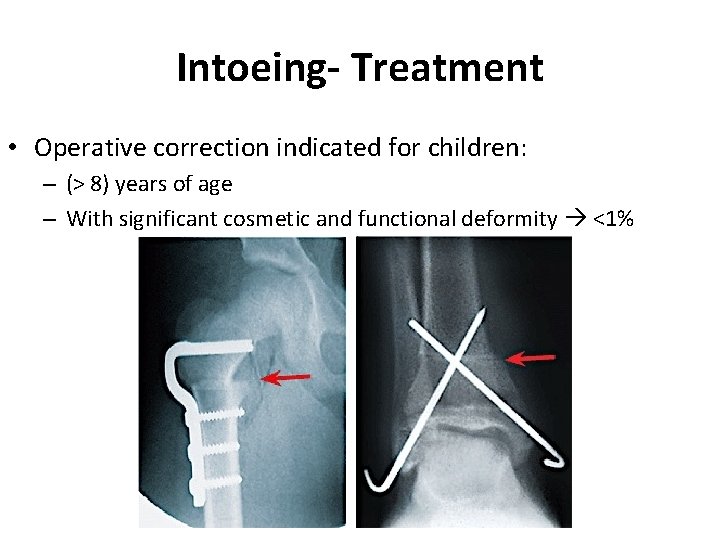 Intoeing- Treatment • Operative correction indicated for children: – (> 8) years of age Intoeing- Treatment • Operative correction indicated for children: – (> 8) years of age