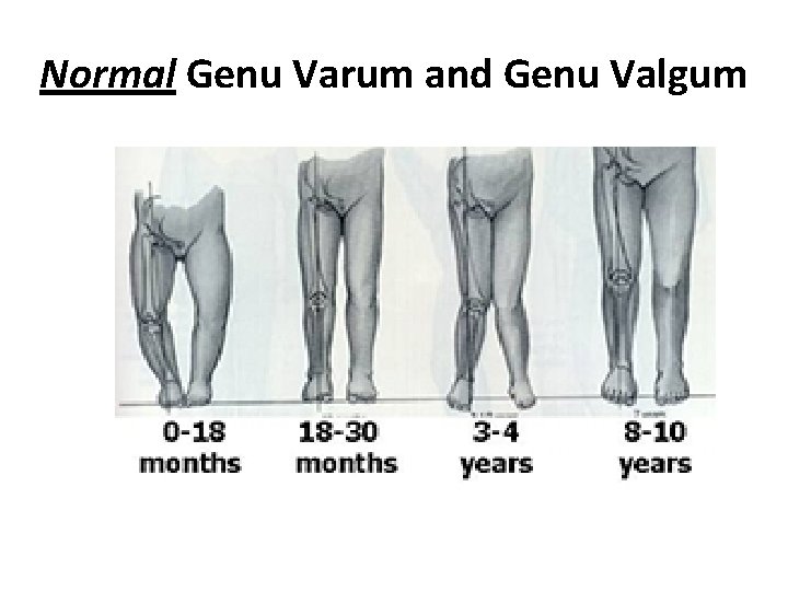 Normal Genu Varum and Genu Valgum Normal Genu Varum and Genu Valgum