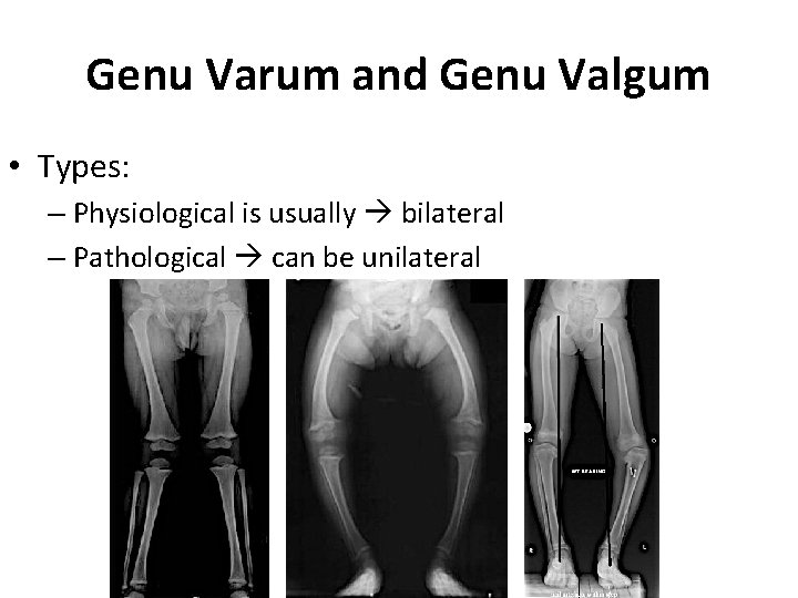 Genu Varum and Genu Valgum • Types: – Physiological is usually bilateral – Pathological Genu Varum and Genu Valgum • Types: – Physiological is usually bilateral – Pathological