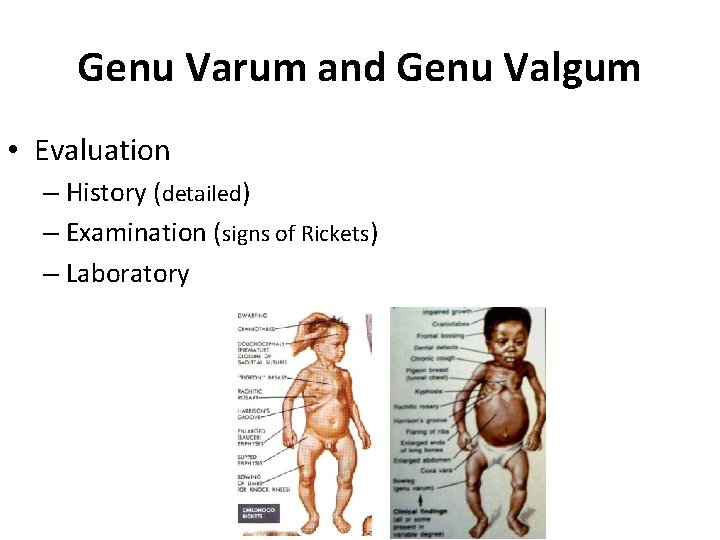 Genu Varum and Genu Valgum • Evaluation – History (detailed) – Examination (signs of Genu Varum and Genu Valgum • Evaluation – History (detailed) – Examination (signs of