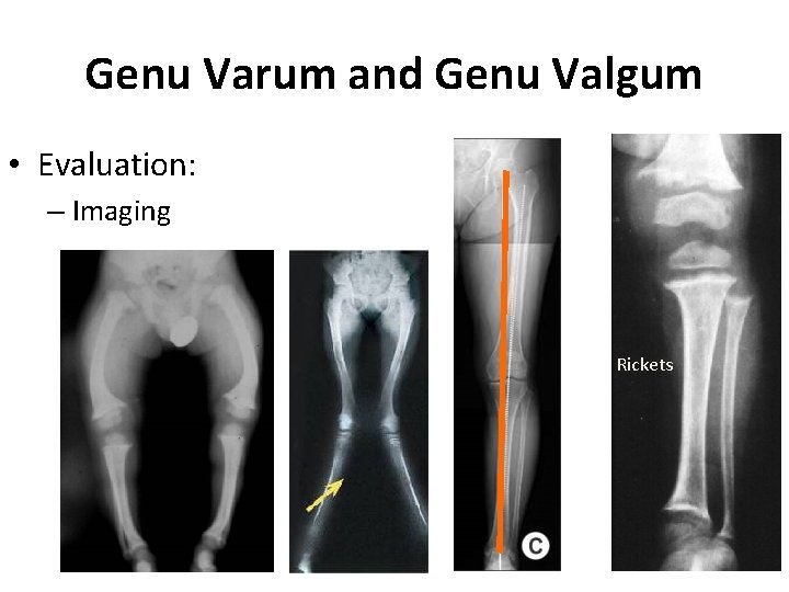 Genu Varum and Genu Valgum • Evaluation: – Imaging Rickets Genu Varum and Genu Valgum • Evaluation: – Imaging Rickets