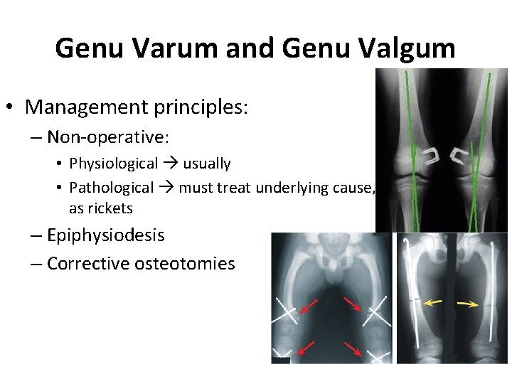 Genu Varum and Genu Valgum • Management principles: – Non-operative: • Physiological usually • Genu Varum and Genu Valgum • Management principles: – Non-operative: • Physiological usually •