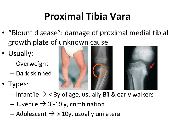 Proximal Tibia Vara • “Blount disease”: damage of proximal medial tibial growth plate of Proximal Tibia Vara • “Blount disease”: damage of proximal medial tibial growth plate of