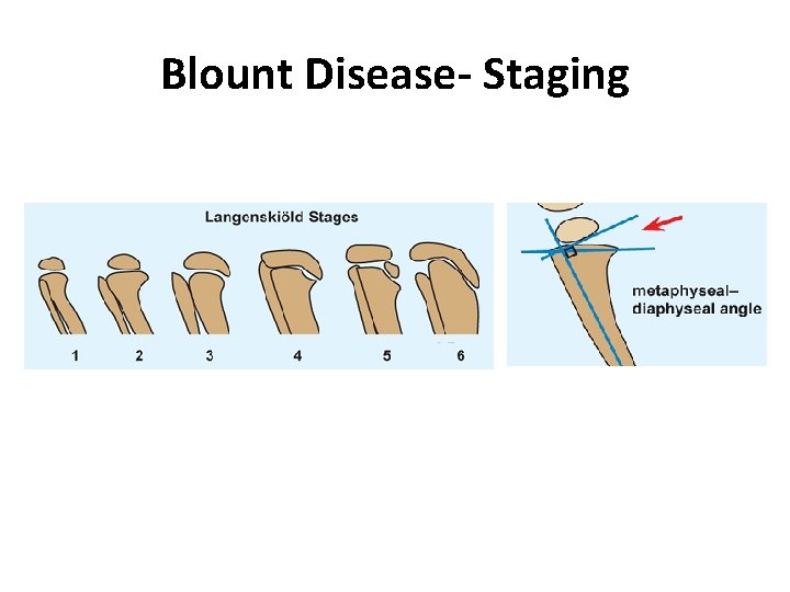 Blount Disease- Staging Blount Disease- Staging