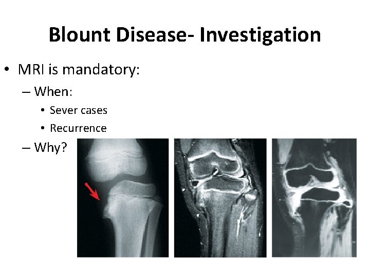 Blount Disease- Investigation • MRI is mandatory: – When: • Sever cases • Recurrence Blount Disease- Investigation • MRI is mandatory: – When: • Sever cases • Recurrence