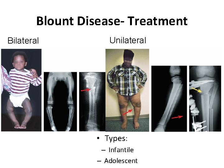 Blount Disease- Treatment Bilateral Unilateral • Types: – Infantile – Adolescent Blount Disease- Treatment Bilateral Unilateral • Types: – Infantile – Adolescent