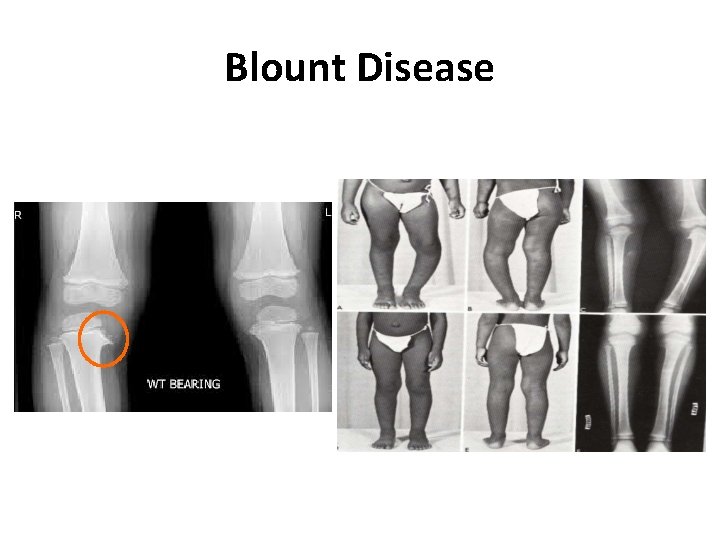 Blount Disease Blount Disease