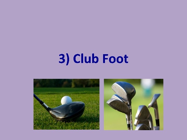 3) Club Foot 3) Club Foot