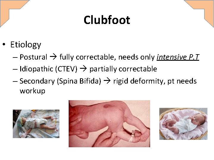 Clubfoot • Etiology – Postural fully correctable, needs only intensive P. T – Idiopathic Clubfoot • Etiology – Postural fully correctable, needs only intensive P. T – Idiopathic