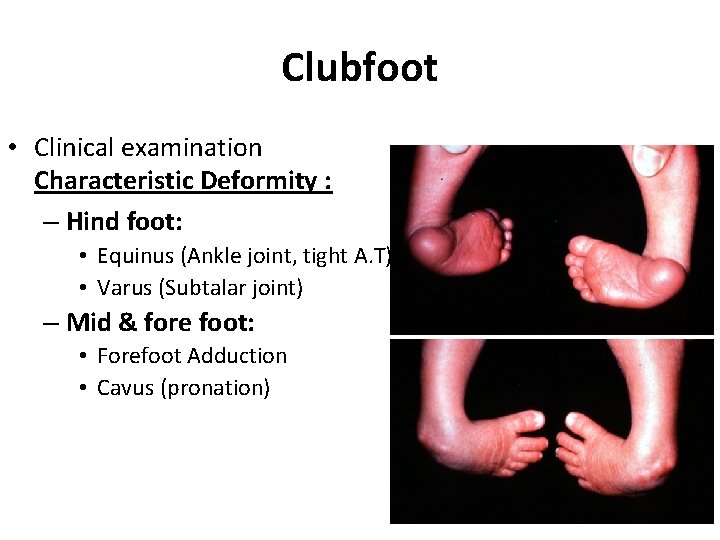 Clubfoot • Clinical examination Characteristic Deformity : – Hind foot: • Equinus (Ankle joint, Clubfoot • Clinical examination Characteristic Deformity : – Hind foot: • Equinus (Ankle joint,