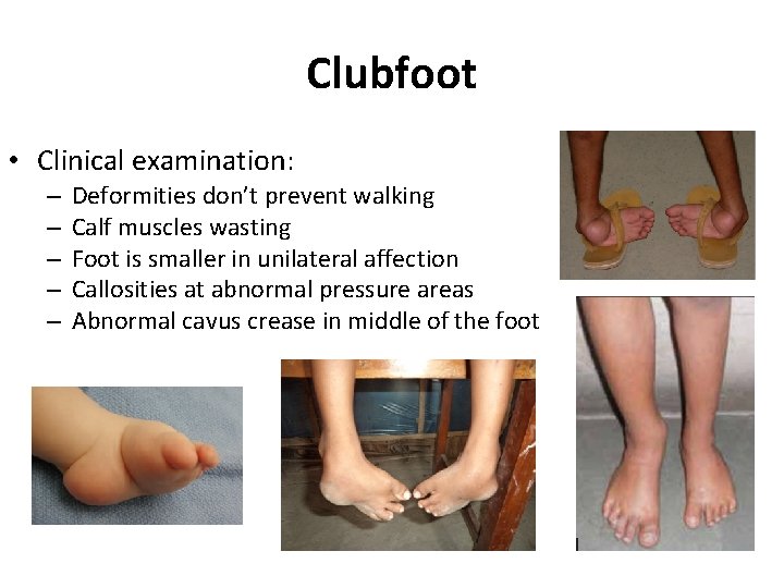 Clubfoot • Clinical examination: – – – Deformities don’t prevent walking Calf muscles wasting Clubfoot • Clinical examination: – – – Deformities don’t prevent walking Calf muscles wasting