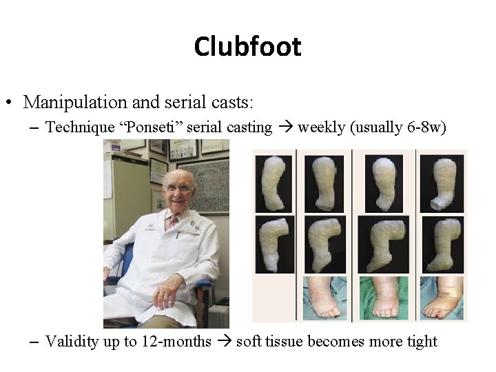 Clubfoot • Manipulation and serial casts: – Technique “Ponseti” serial casting weekly (usually 6 Clubfoot • Manipulation and serial casts: – Technique “Ponseti” serial casting weekly (usually 6