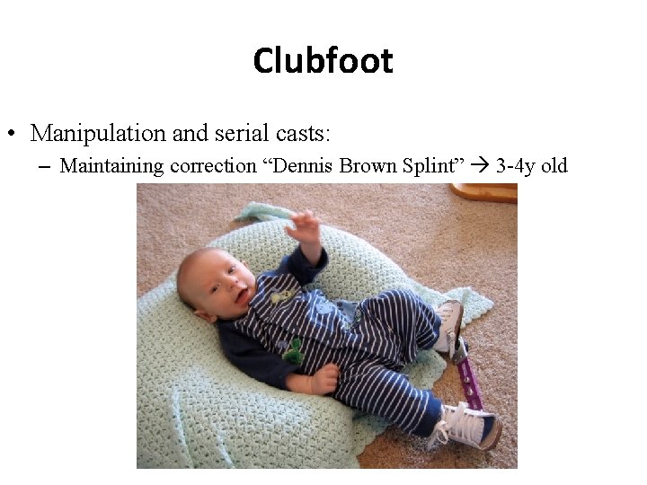 Clubfoot • Manipulation and serial casts: – Maintaining correction “Dennis Brown Splint” 3 -4 Clubfoot • Manipulation and serial casts: – Maintaining correction “Dennis Brown Splint” 3 -4