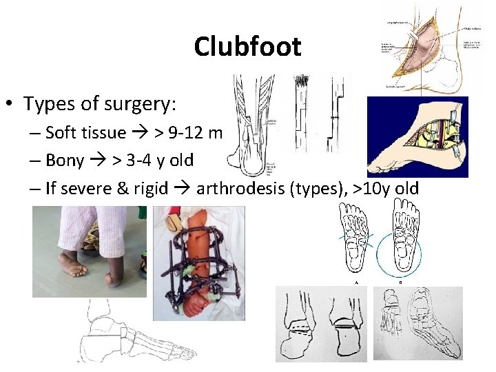 Clubfoot • Types of surgery: – Soft tissue > 9 -12 m old – Clubfoot • Types of surgery: – Soft tissue > 9 -12 m old –