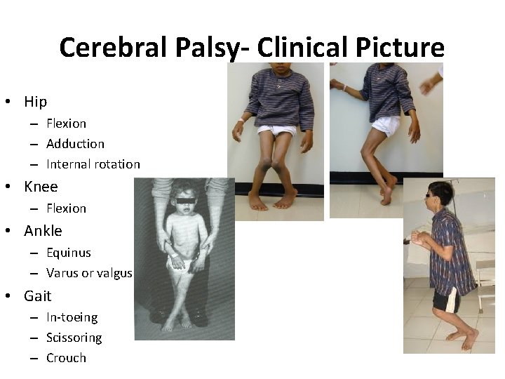 Cerebral Palsy- Clinical Picture • Hip – Flexion – Adduction – Internal rotation • Cerebral Palsy- Clinical Picture • Hip – Flexion – Adduction – Internal rotation •