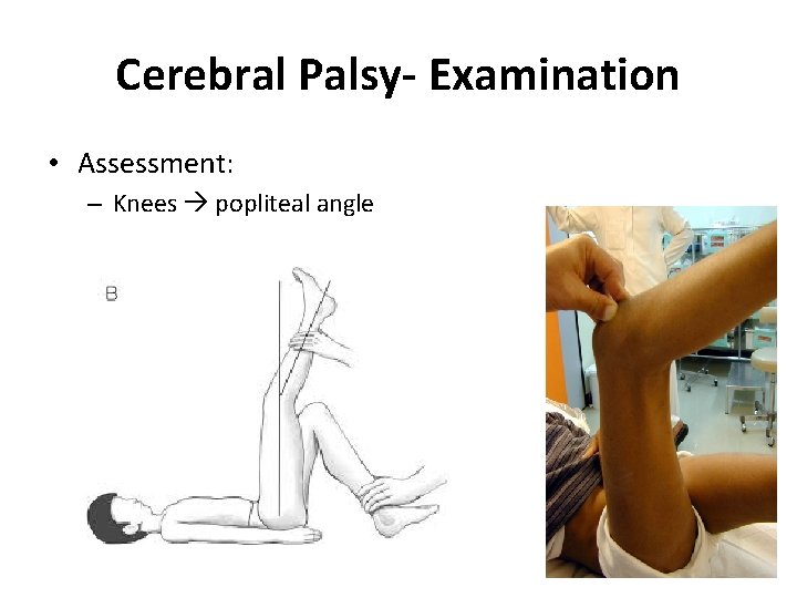 Cerebral Palsy- Examination • Assessment: – Knees popliteal angle Cerebral Palsy- Examination • Assessment: – Knees popliteal angle