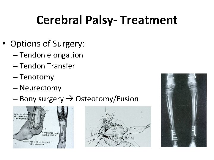 Cerebral Palsy- Treatment • Options of Surgery: – Tendon elongation – Tendon Transfer – Cerebral Palsy- Treatment • Options of Surgery: – Tendon elongation – Tendon Transfer –