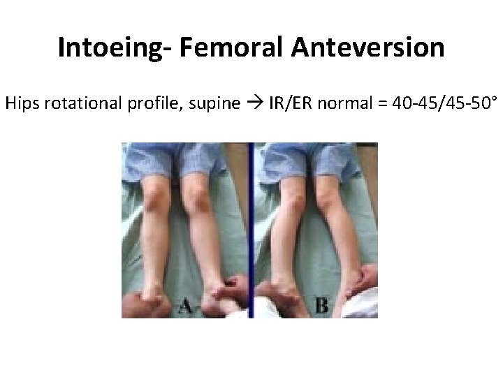 Intoeing- Femoral Anteversion Hips rotational profile, supine IR/ER normal = 40 -45/45 -50° Intoeing- Femoral Anteversion Hips rotational profile, supine IR/ER normal = 40 -45/45 -50°