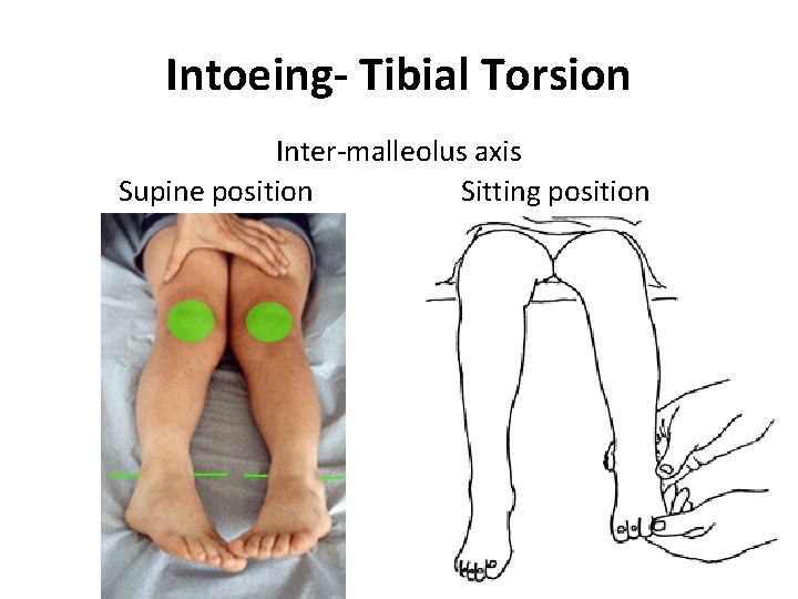 Intoeing- Tibial Torsion Inter-malleolus axis Supine position Sitting position Intoeing- Tibial Torsion Inter-malleolus axis Supine position Sitting position