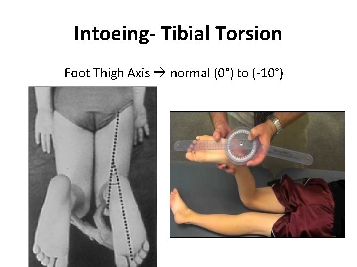 Intoeing- Tibial Torsion Foot Thigh Axis normal (0°) to (-10°) Intoeing- Tibial Torsion Foot Thigh Axis normal (0°) to (-10°)