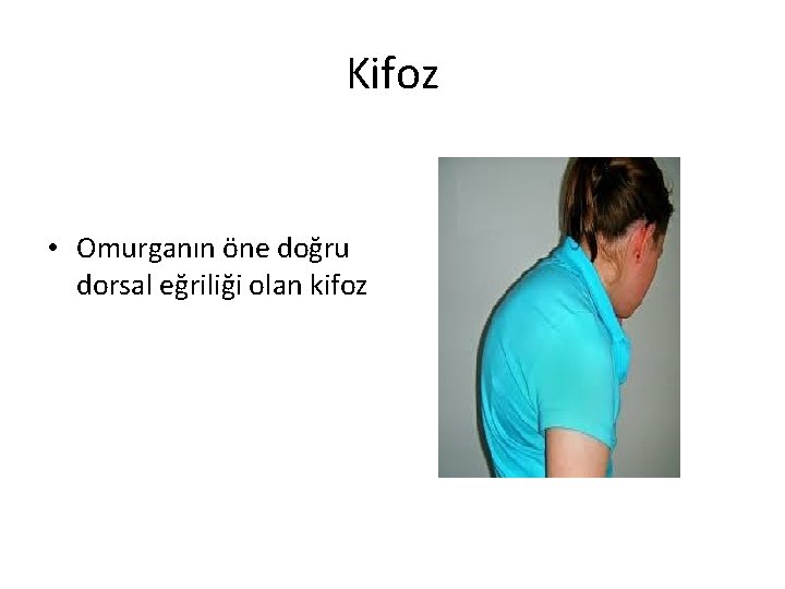 Kifoz • Omurganın öne doğru dorsal eğriliği olan kifoz 