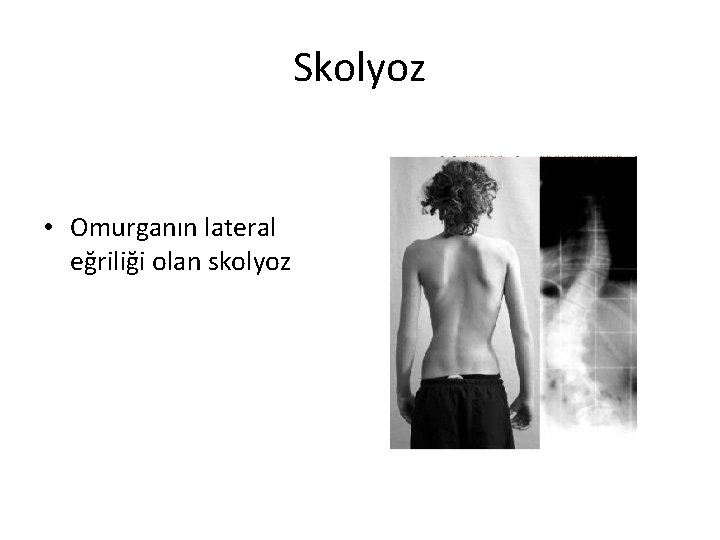 Skolyoz • Omurganın lateral eğriliği olan skolyoz 