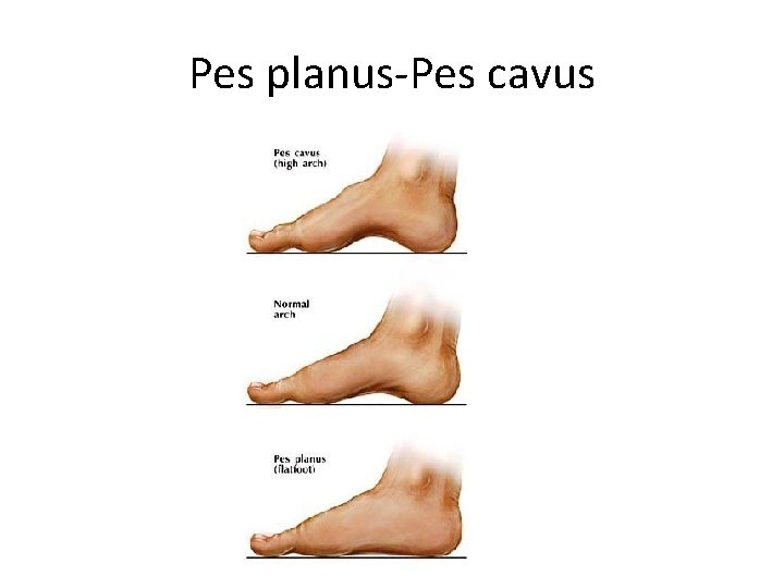 Pes planus-Pes cavus 