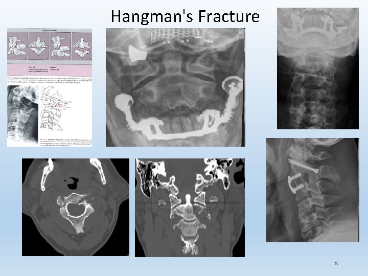 Hangman's Fracture 10 
