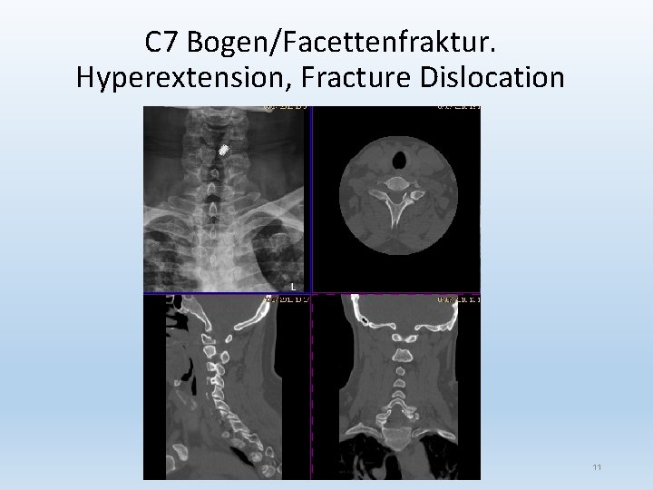 C 7 Bogen/Facettenfraktur. Hyperextension, Fracture Dislocation 11 