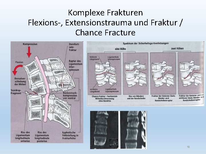 Komplexe Frakturen Flexions-, Extensionstrauma und Fraktur / Chance Fracture 12 