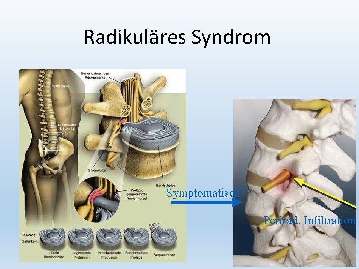 Radikuläres Syndrom Symptomatisch? Perirad. Infiltration 17 