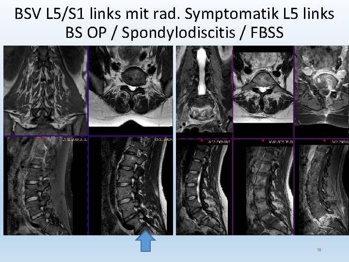 BSV L 5/S 1 links mit rad. Symptomatik L 5 links BS OP /