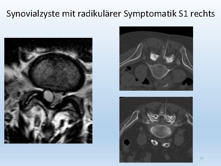 Synovialzyste mit radikulärer Symptomatik S 1 rechts 21 