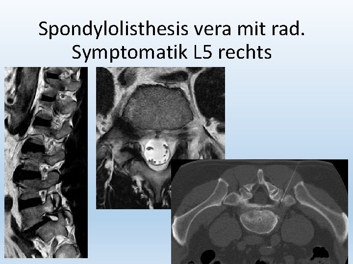 Spondylolisthesis vera mit rad. Symptomatik L 5 rechts 22 