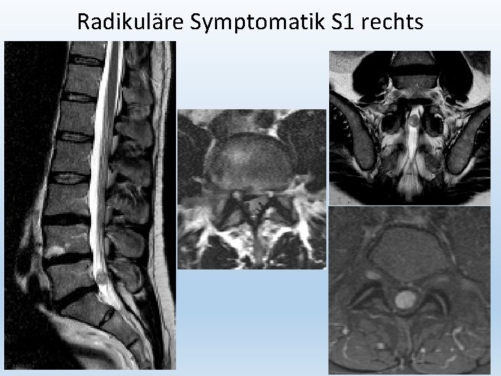 Radikuläre Symptomatik S 1 rechts 26 