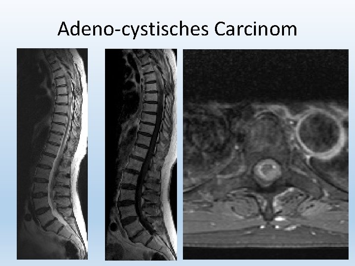 Adeno-cystisches Carcinom 27 