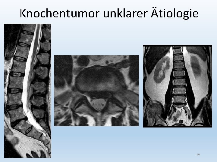 Knochentumor unklarer Ätiologie 28 