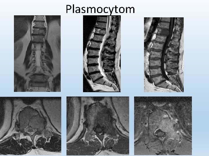 Plasmocytom 29 